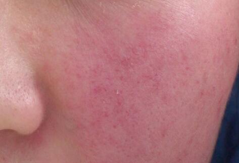 如何拯救你的敏感?。繌V西南寧美容培訓叫你正確方法