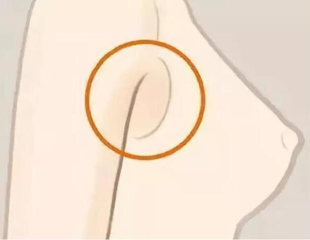 減副乳，瘦手臂一招就解決！