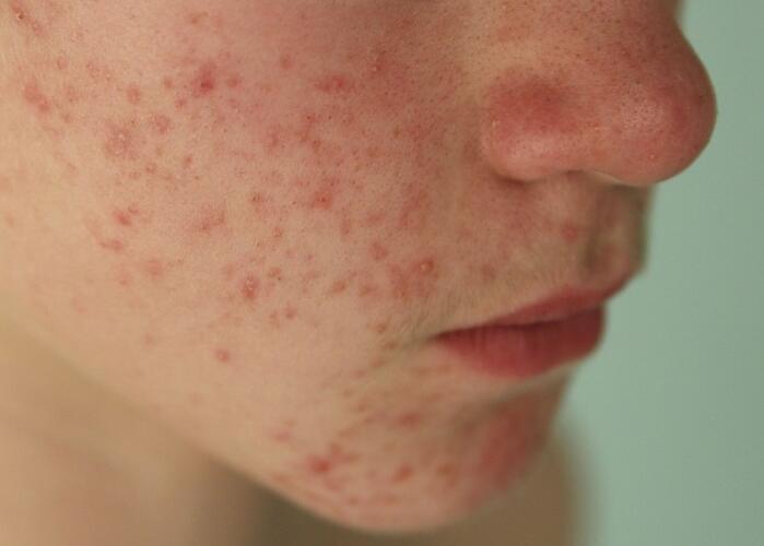 粉刺閉口應(yīng)該如何處理？