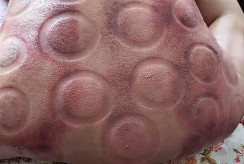 怎樣拔火罐？南寧美容學(xué)校手把手教你