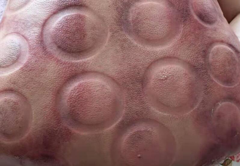 拔火罐有什么用？廣西美容職業(yè)培訓(xùn)學(xué)校演示給你看