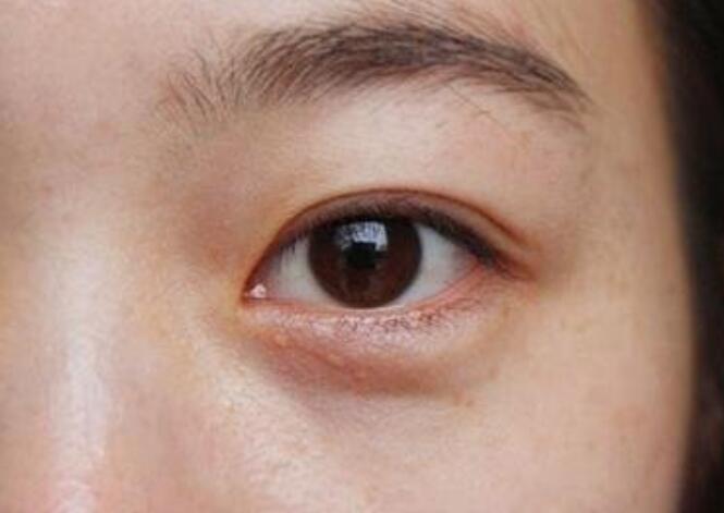 黑眼圈的種類有哪些？廣西美容培訓教你保養(yǎng)