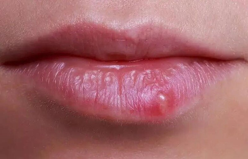 紋唇后起泡怎么辦？南寧紋唇培訓(xùn)學(xué)校教你方法