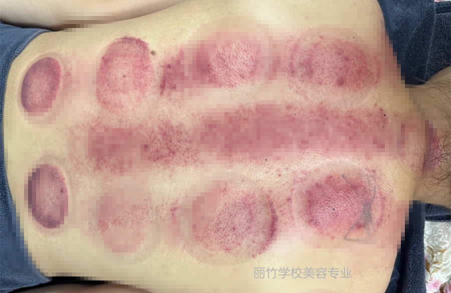 拔火罐的顏色代表什么？南寧美容美體專業(yè)實(shí)訓(xùn)