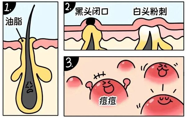 不同部位閉口形成的原因，南寧美容護(hù)膚學(xué)校解答