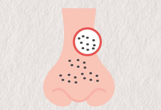 廣西皮膚管理師：面對(duì)嚴(yán)重的黑頭應(yīng)該怎么辦？